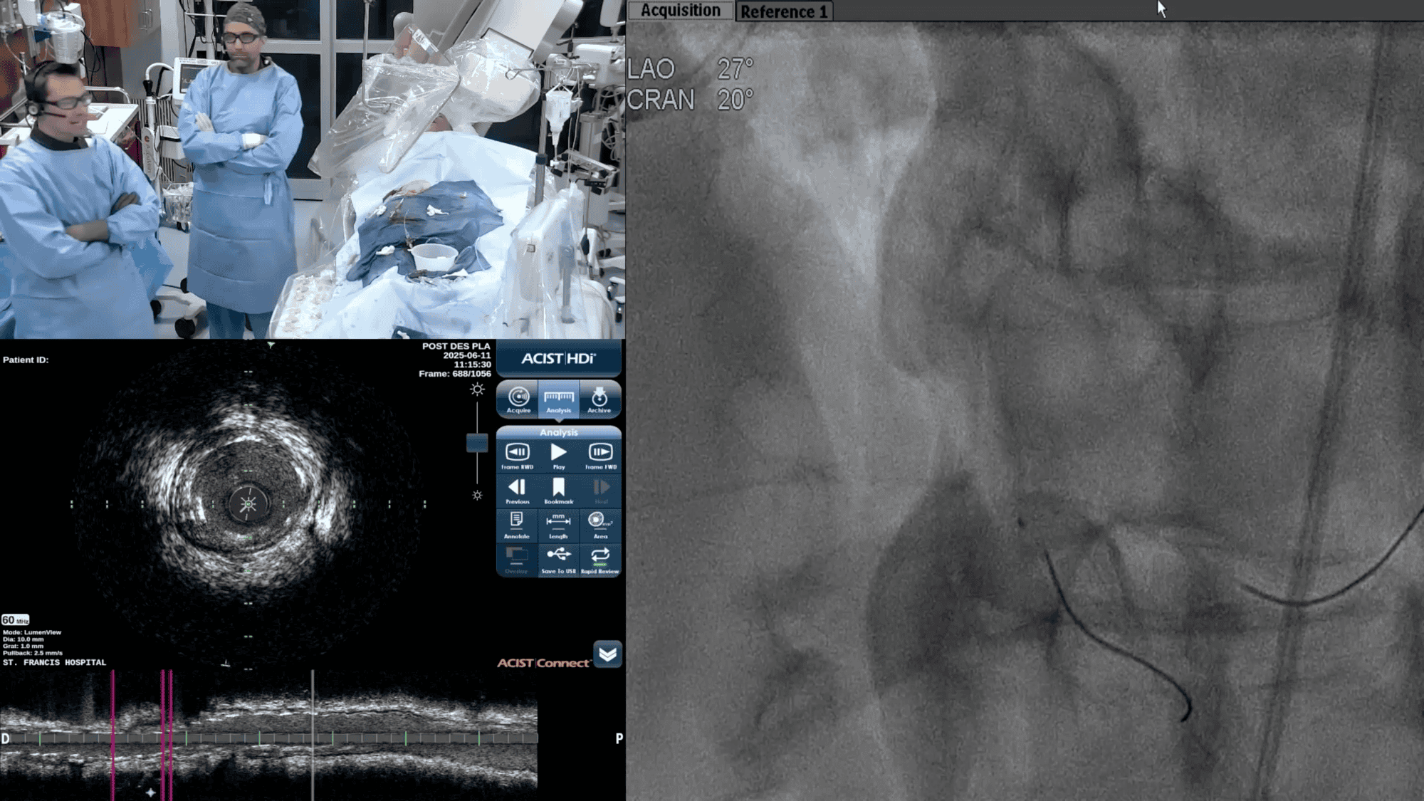 Screenshot from IVUS and Physiology Help Facilitate Ultra  Low Contrast Use in Complex PCIs video
